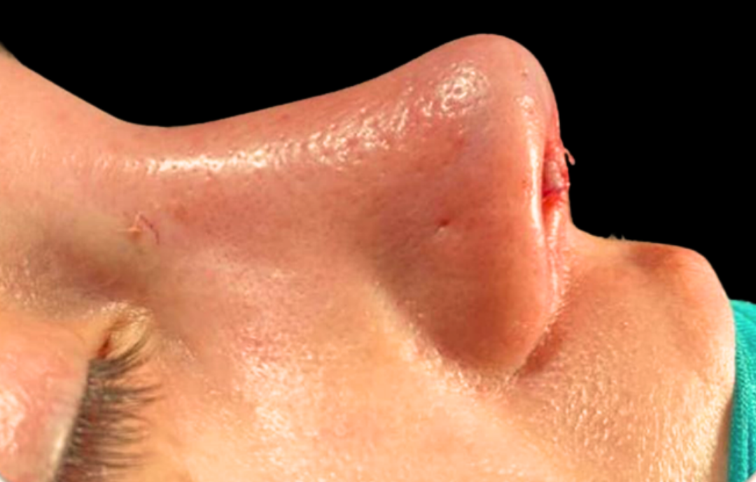 Piezo Burun Estetiği Antalya