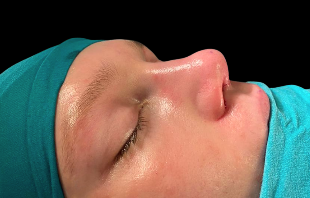 antalya revizyon burun estetiği